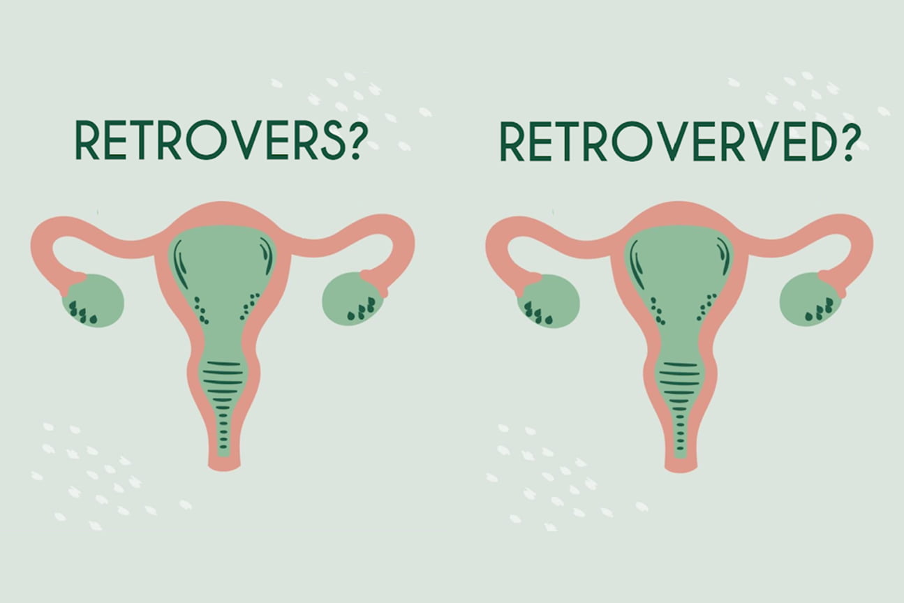 Uter orientat posterior? Sau doar confuz cu termenii medicali?